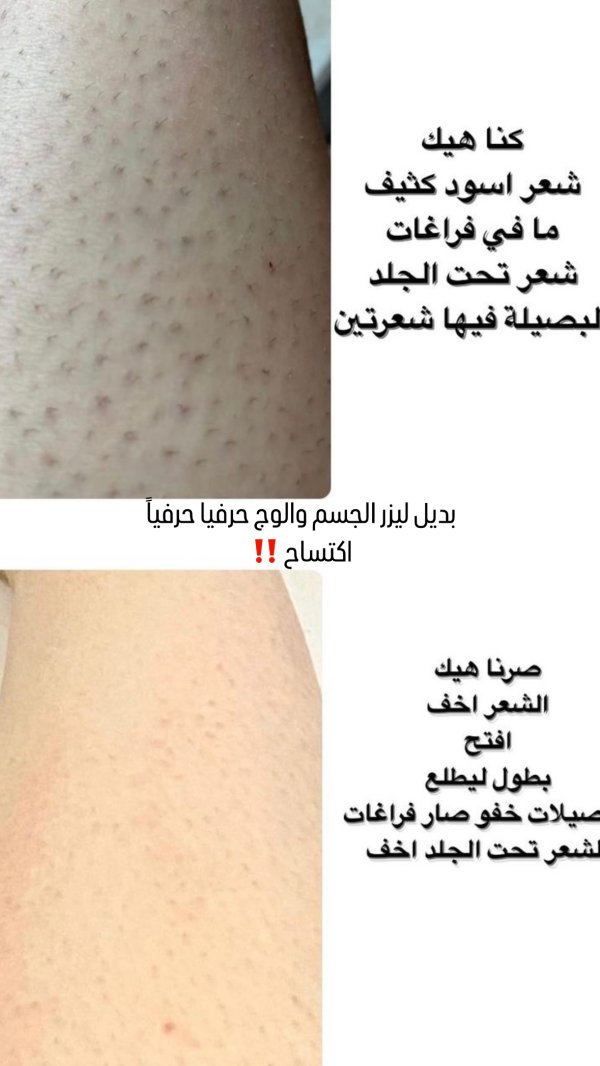 بديل الليزر و نتائجه